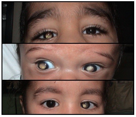 retinoblastoma